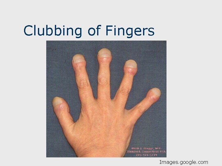 Clubbing of Fingers Images. google. com 