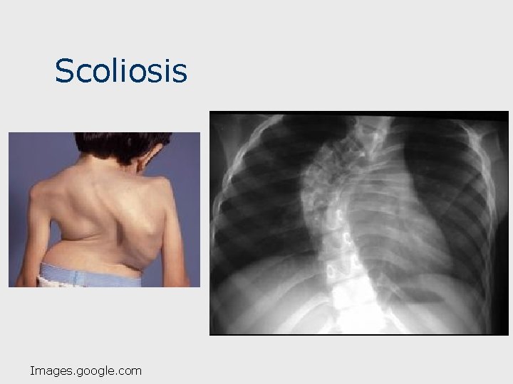 Scoliosis Images. google. com 