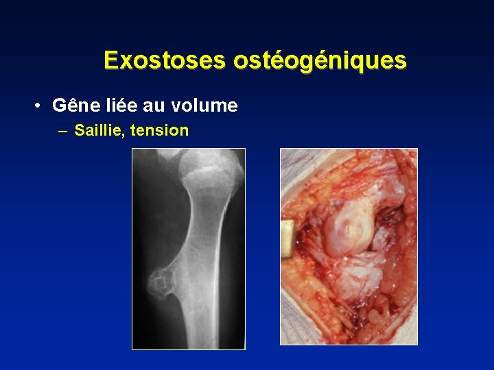 Exostoses ostéogéniques • Gêne liée au volume – Saillie, tension 