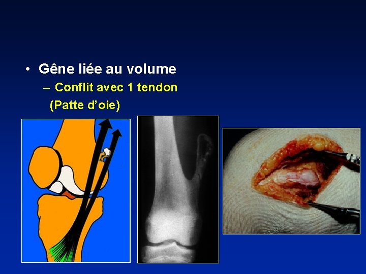  • Gêne liée au volume – Conflit avec 1 tendon (Patte d’oie) 
