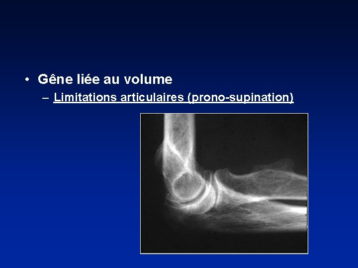  • Gêne liée au volume – Limitations articulaires (prono-supination) 