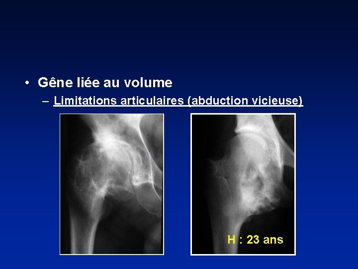  • Gêne liée au volume – Limitations articulaires (abduction vicieuse) H : 23