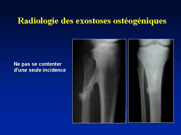 Radiologie des exostoses ostéogéniques Ne pas se contenter d’une seule incidence 