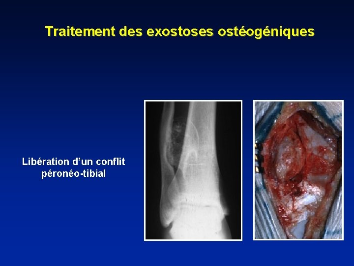 Traitement des exostoses ostéogéniques Libération d’un conflit péronéo-tibial 