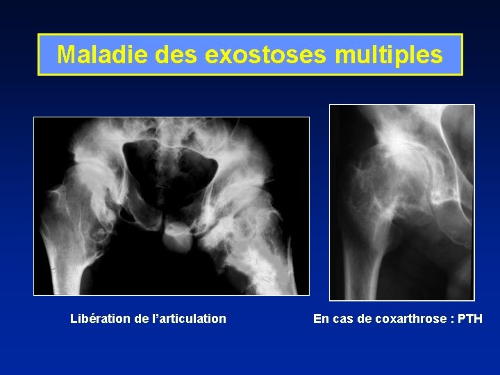 Maladie des exostoses multiples Libération de l’articulation En cas de coxarthrose : PTH 