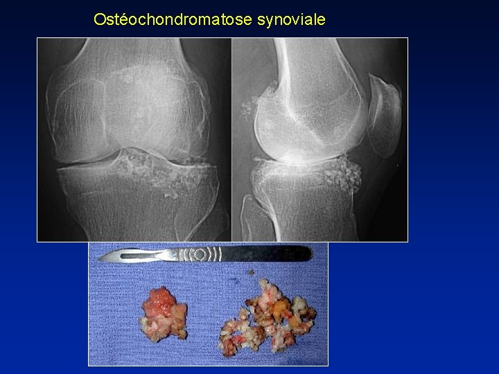 Ostéochondromatose synoviale 