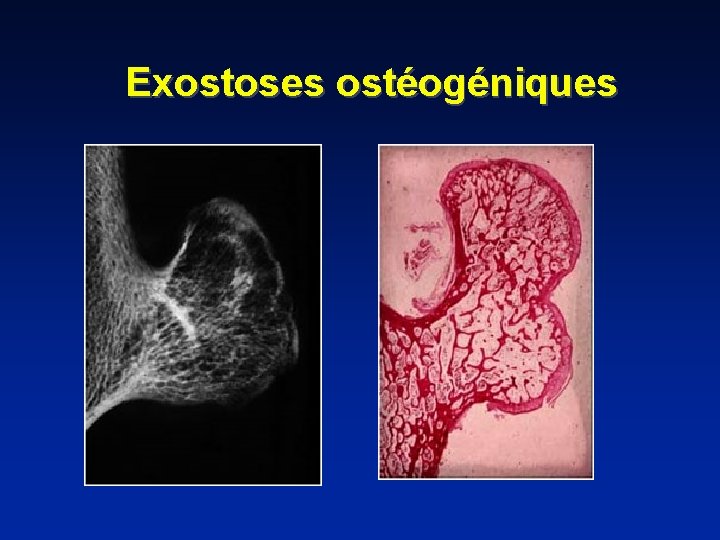 Exostoses ostéogéniques 