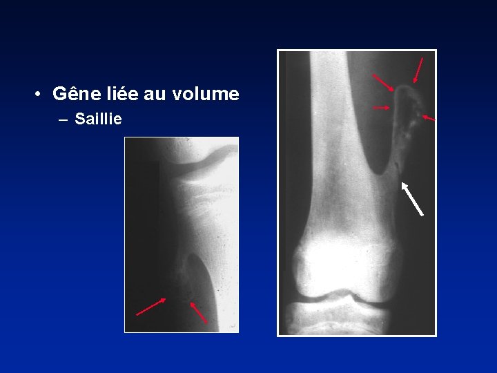  • Gêne liée au volume – Saillie 