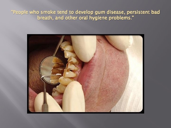 “People who smoke tend to develop gum disease, persistent bad breath, and other oral