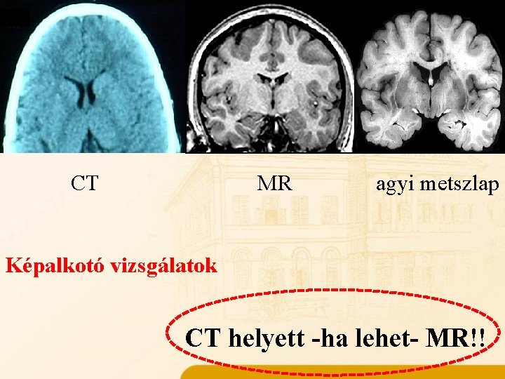 Műtéti kivizsgálás elemei Anamnézis CT MR agyi metszlap Képalkotó vizsgálatok CT helyett -ha lehet-