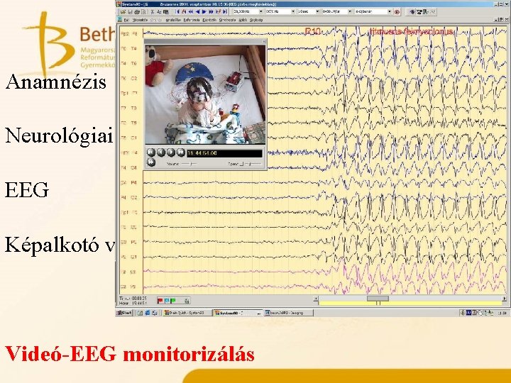 Műtéti kivizsgálás elemei Anamnézis Neurológiai vizsgálat EEG Képalkotó vizsgálatok Videó-EEG monitorizálás 