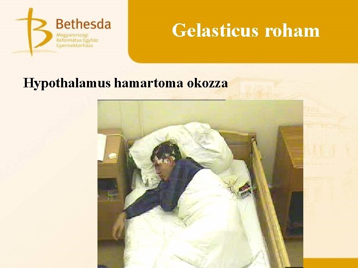 Gelasticus roham Hypothalamus hamartoma okozza 