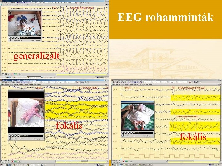 EEG rohamminták generalizált fokális 