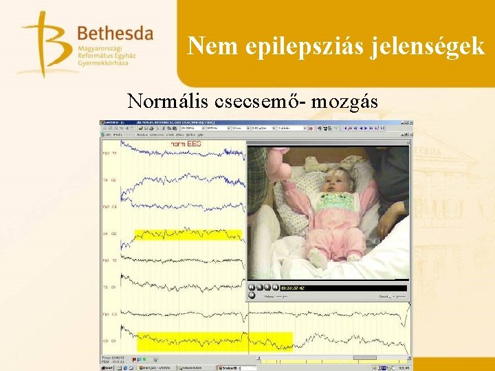 Nem epilepsziás jelenségek Normális csecsemő- mozgás 