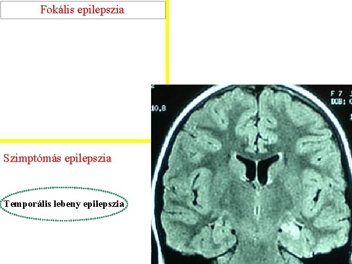 Fokális epilepszia Szimptómás epilepszia Temporális lebeny epilepszia 