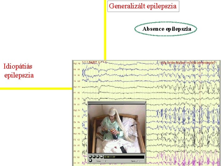 Generalizált epilepszia Absence epilepszia Idiopátiás epilepszia 