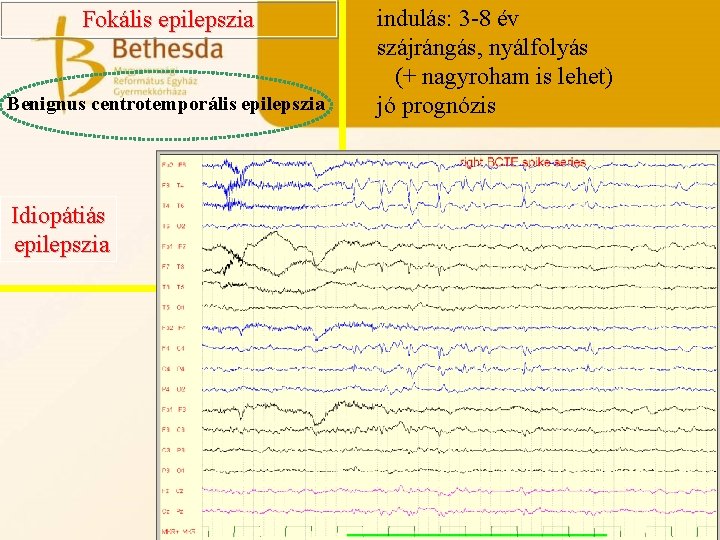 Fokális epilepszia Benignus centrotemporális epilepszia Idiopátiás epilepszia indulás: 3 -8 év szájrángás, nyálfolyás (+