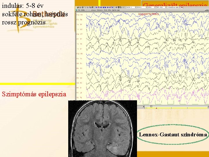 indulás: 5 -8 év sokféle roham, leépülés rossz prognózis Generalizált epilepszia Szimptómás epilepszia Lennox-Gastaut