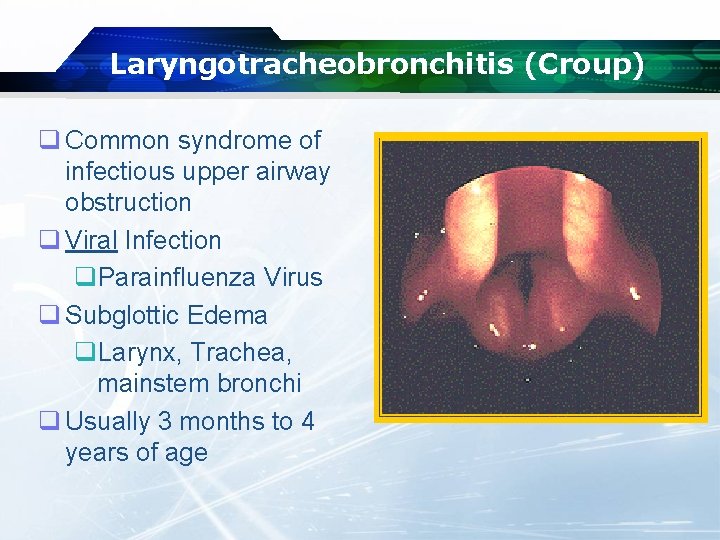 Laryngotracheobronchitis (Croup) q Common syndrome of infectious upper airway obstruction q Viral Infection q.