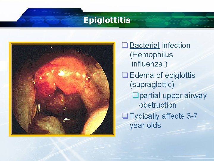 Epiglottitis q Bacterial infection (Hemophilus influenza ) q Edema of epiglottis (supraglottic) qpartial upper