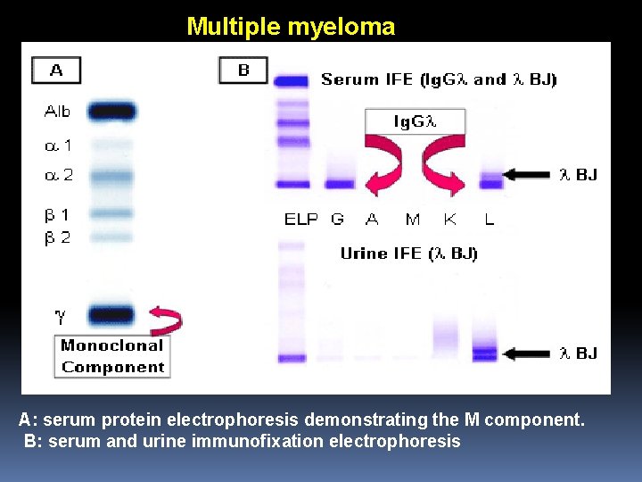 Multiple myeloma A: serum protein electrophoresis demonstrating the M component. B: serum and urine