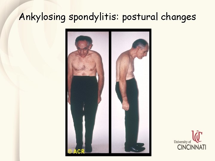 Ankylosing spondylitis: postural changes 