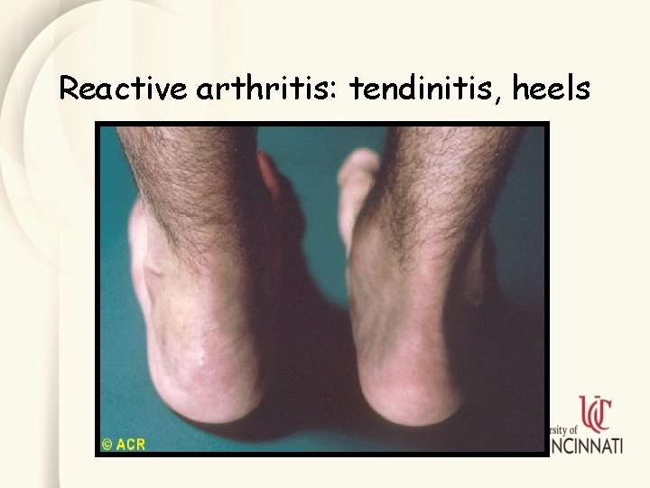 Reactive arthritis: tendinitis, heels 