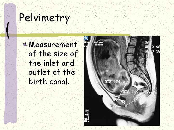 Pelvimetry Measurement of the size of the inlet and outlet of the birth canal.