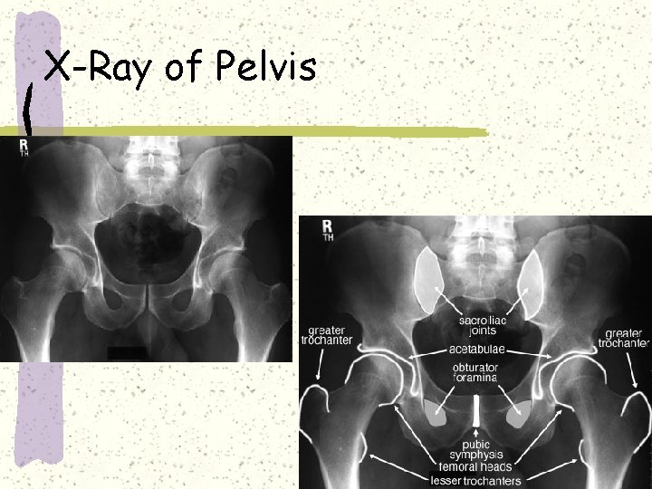 X-Ray of Pelvis 