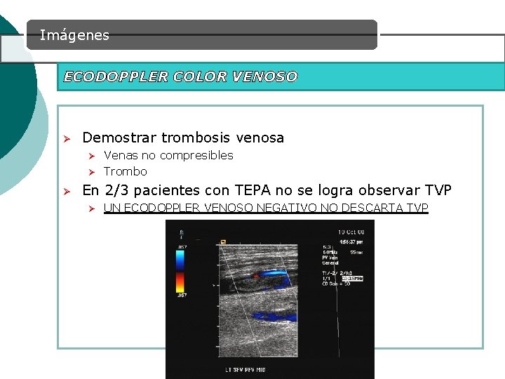 Imágenes ECODOPPLER COLOR VENOSO Ø Demostrar trombosis venosa Ø Ø Ø Venas no compresibles