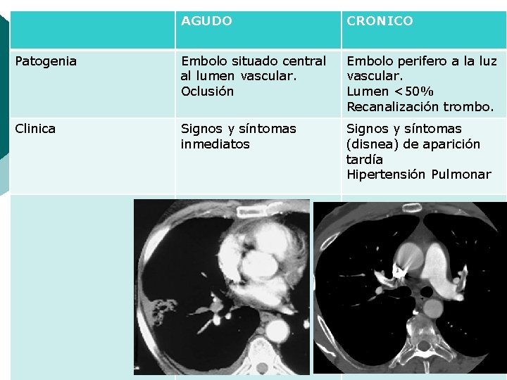 AGUDO CRONICO Patogenia Embolo situado central al lumen vascular. Oclusión Embolo perifero a la