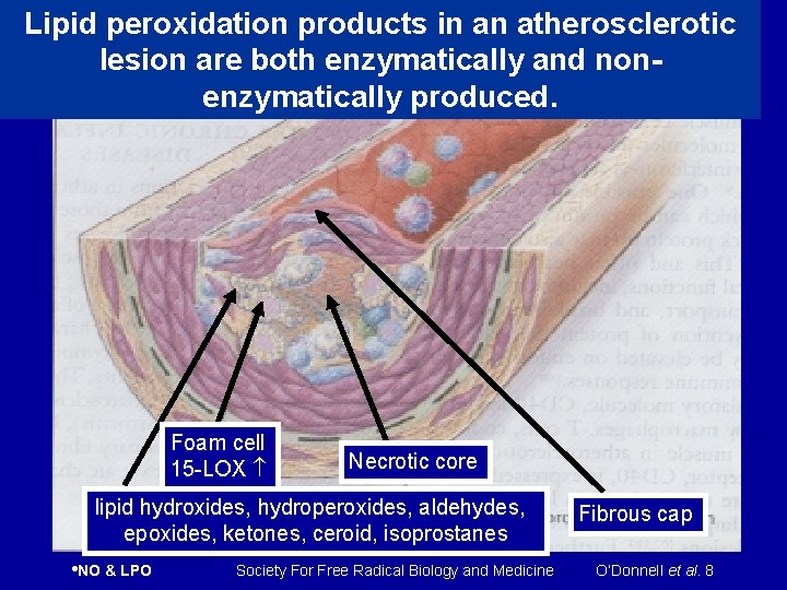 Lipid peroxidation products in an atherosclerotic lesion are both enzymatically and nonenzymatically produced. Foam