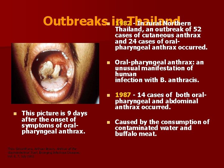 1982 - In rural Northern Outbreaksn in Thailand, an outbreak of 52 cases of