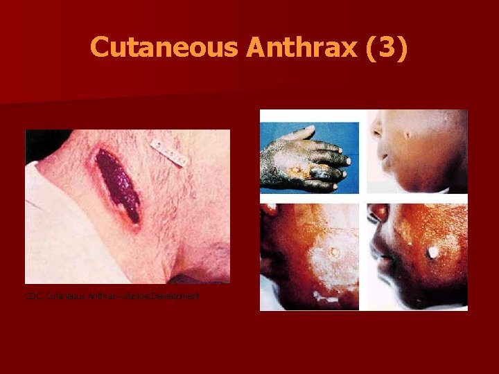 Cutaneous Anthrax (3) CDC, Cutaneous Anthrax—Vesicle Development 