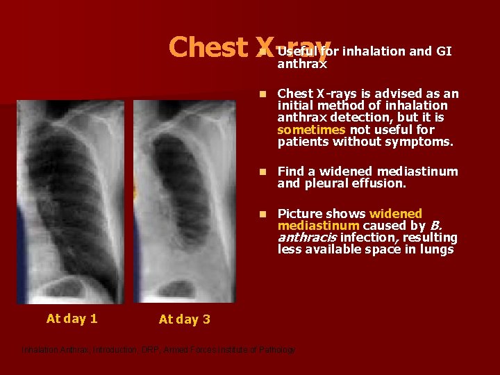 Useful for inhalation and GI Chest X-ray anthrax n At day 1 n Chest