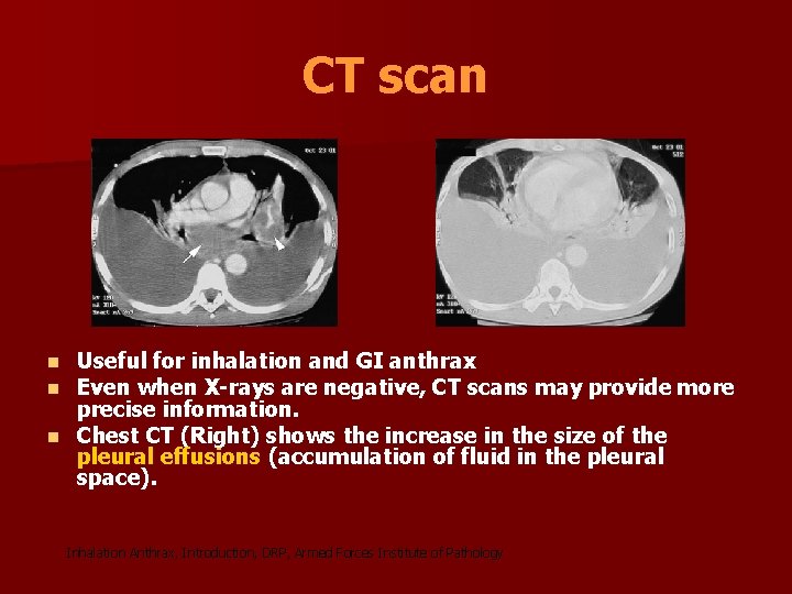 CT scan Useful for inhalation and GI anthrax Even when X-rays are negative, CT