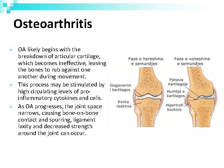 Osteoarthritis • • • OA likely begins with the breakdown of articular cartilage, which