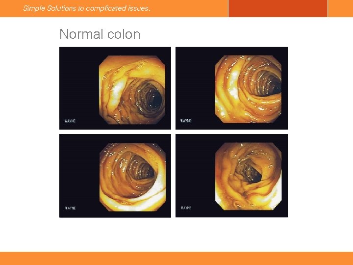 Normal colon 