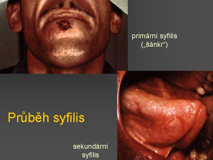 primární syfilis („šánkr“) Průběh syfilis sekundární syfilis 