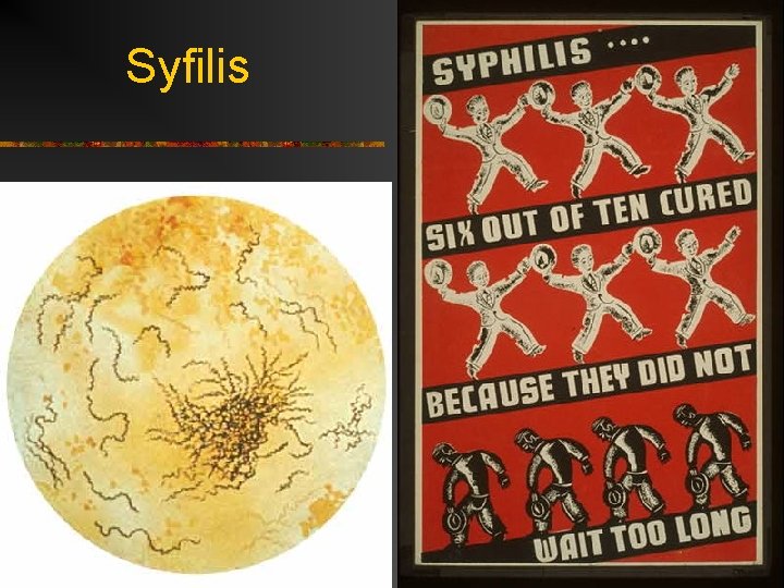 Syfilis 