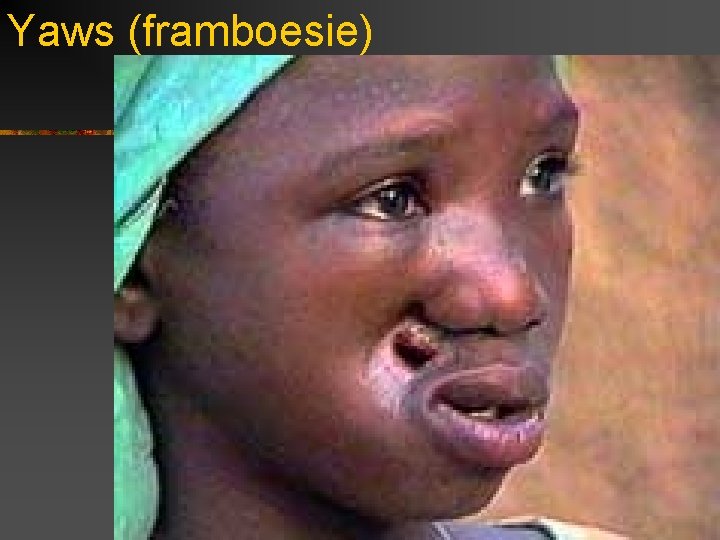 Yaws (framboesie) 