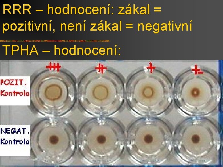 RRR – hodnocení: zákal = pozitivní, není zákal = negativní TPHA – hodnocení: 