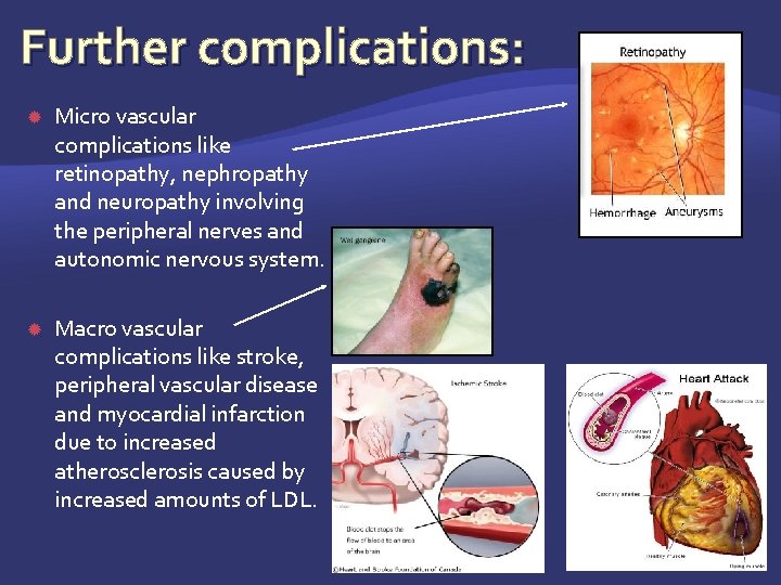 Further complications: Micro vascular complications like retinopathy, nephropathy and neuropathy involving the peripheral nerves