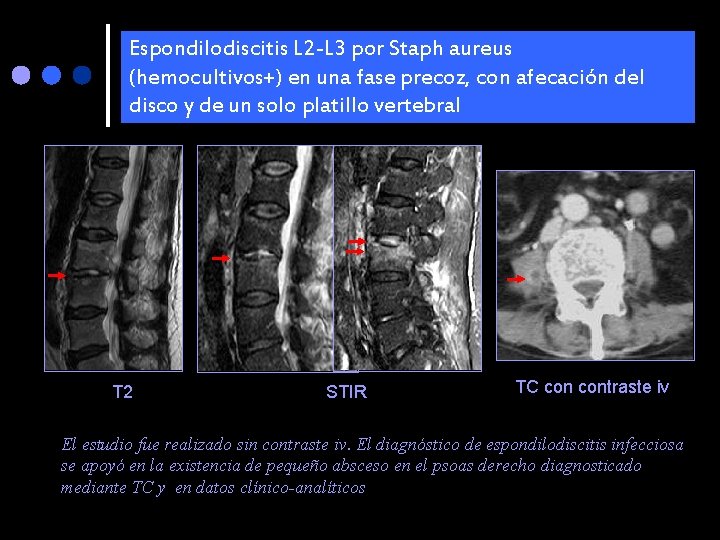 Espondilodiscitis L 2 -L 3 por Staph aureus (hemocultivos+) en una fase precoz, con