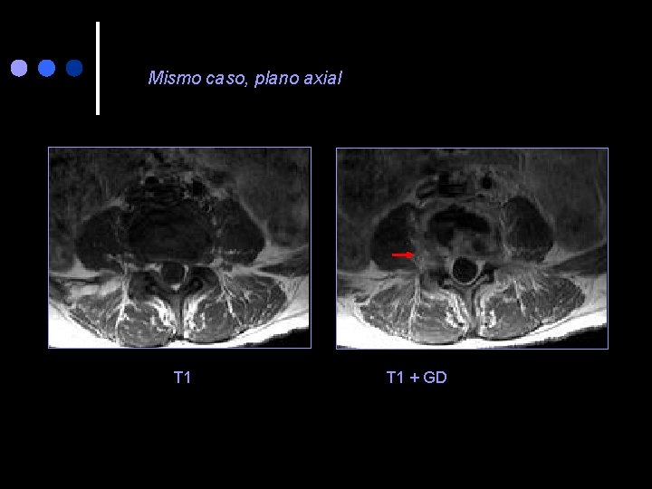 Mismo caso, plano axial T 1 + GD 