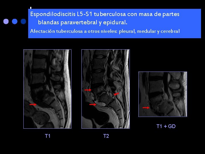 Espondilodiscitis L 5 -S 1 tuberculosa con masa de partes blandas paravertebral y epidural.