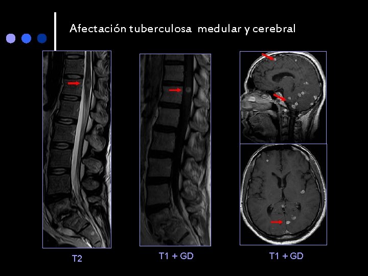 Afectación tuberculosa medular y cerebral T 2 T 1 + GD 