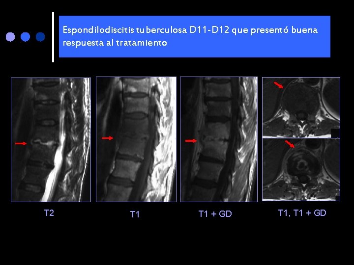 Espondilodiscitis tuberculosa D 11 -D 12 que presentó buena respuesta al tratamiento T 2