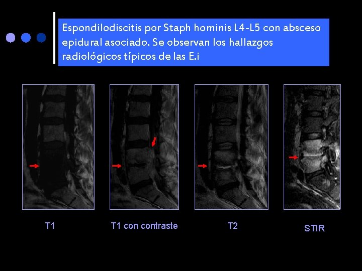 Espondilodiscitis por Staph hominis L 4 -L 5 con absceso epidural asociado. Se observan