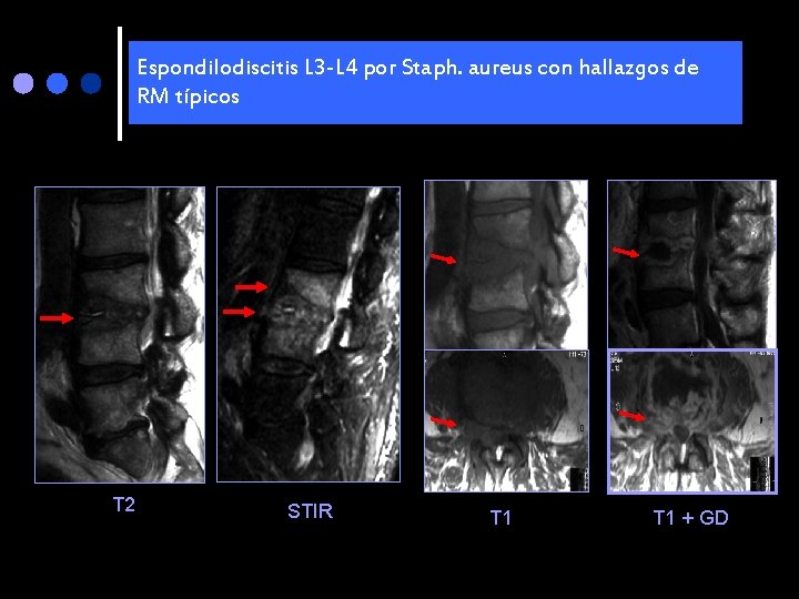 Espondilodiscitis L 3 -L 4 por Staph. aureus con hallazgos de RM típicos T